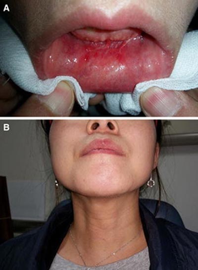 عملية تجميل الذقن من داخل الفم