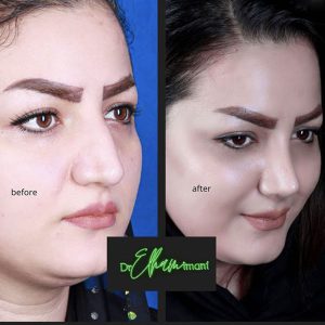عکس قبل و بعد عمل بینی گوشتی در مشهد توسط دکتر ایمانی