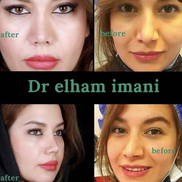 نموذج تجميل الانف للنساء مع الدكتورة الهام ايماني في مشهد ايران