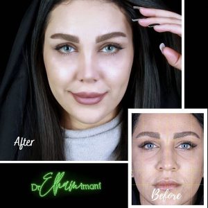 عکس قبل و بعد نمونه کار دکتر ایمانی جراح زیبایی خانم در مشهد