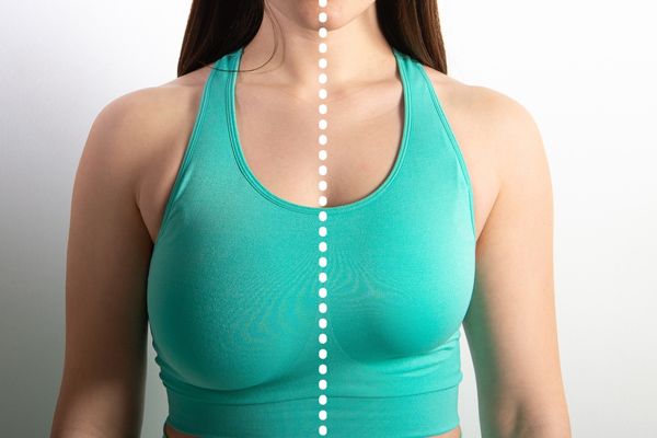 قبل و بعد از عمل ماموپلاستی یا کوچک کردن سینه زنان