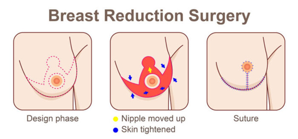 كيف تتم عملية تصغير الثدي أو ماموبلاستي