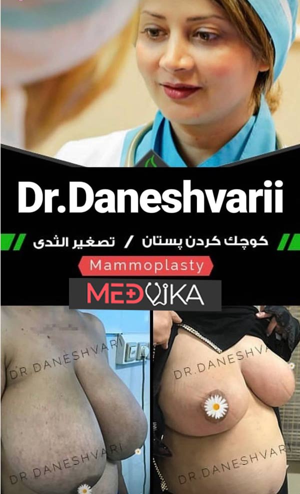 افضل دكتور تصغير الثدي في ايران