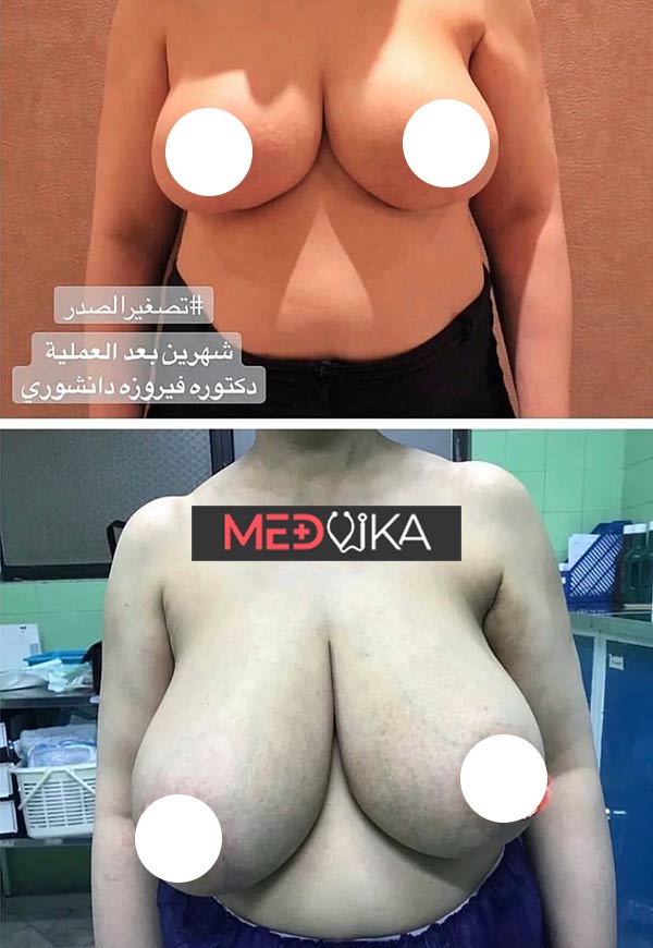 تجارب تصغير الثدي طبيعياً في ايران