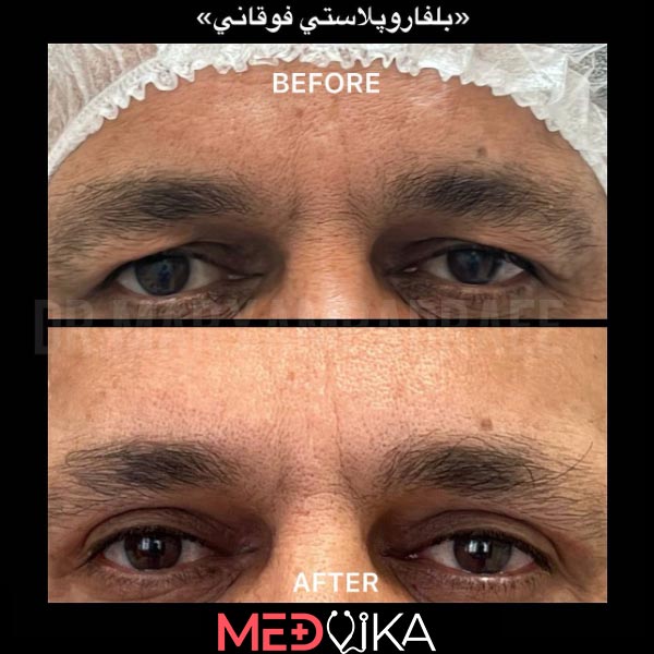 جراحی پلک چشم در مشهد