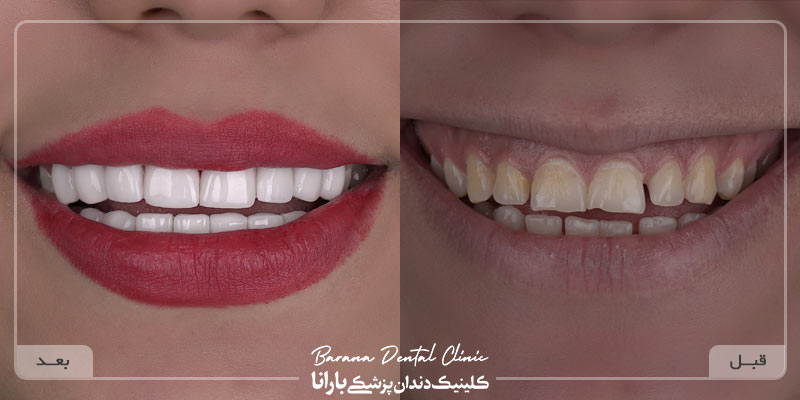قبل و بعد از لمینت دندان مشهد