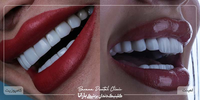 لیمنت و کامپوزیت دندان در مشهد