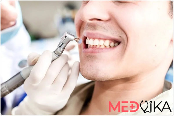 پالیش کامپوزیت دندان چیست 