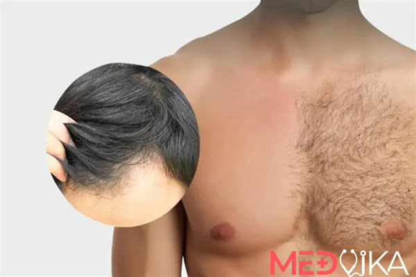 کاشت مو بدون بانک مو یا با استفاده از موی بخش های مختلف بدن