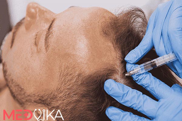 کاشت مو از طریق تزریق سلول های بنیادی به سر